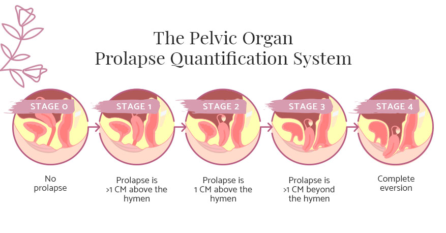 pelvic organ prolapse quantification system