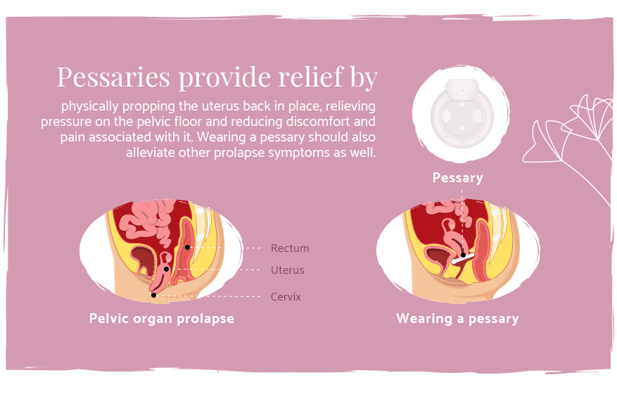 pessaries provide prolapse relief