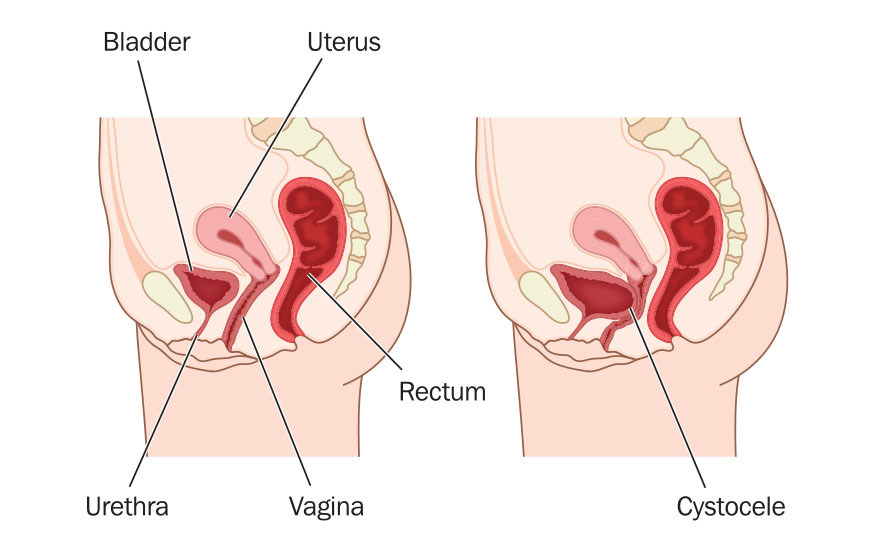 prolapsed bladder diagram illustrated