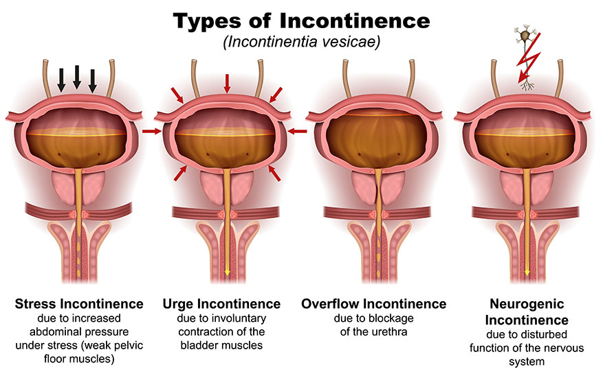 urinary incontinence types illustration